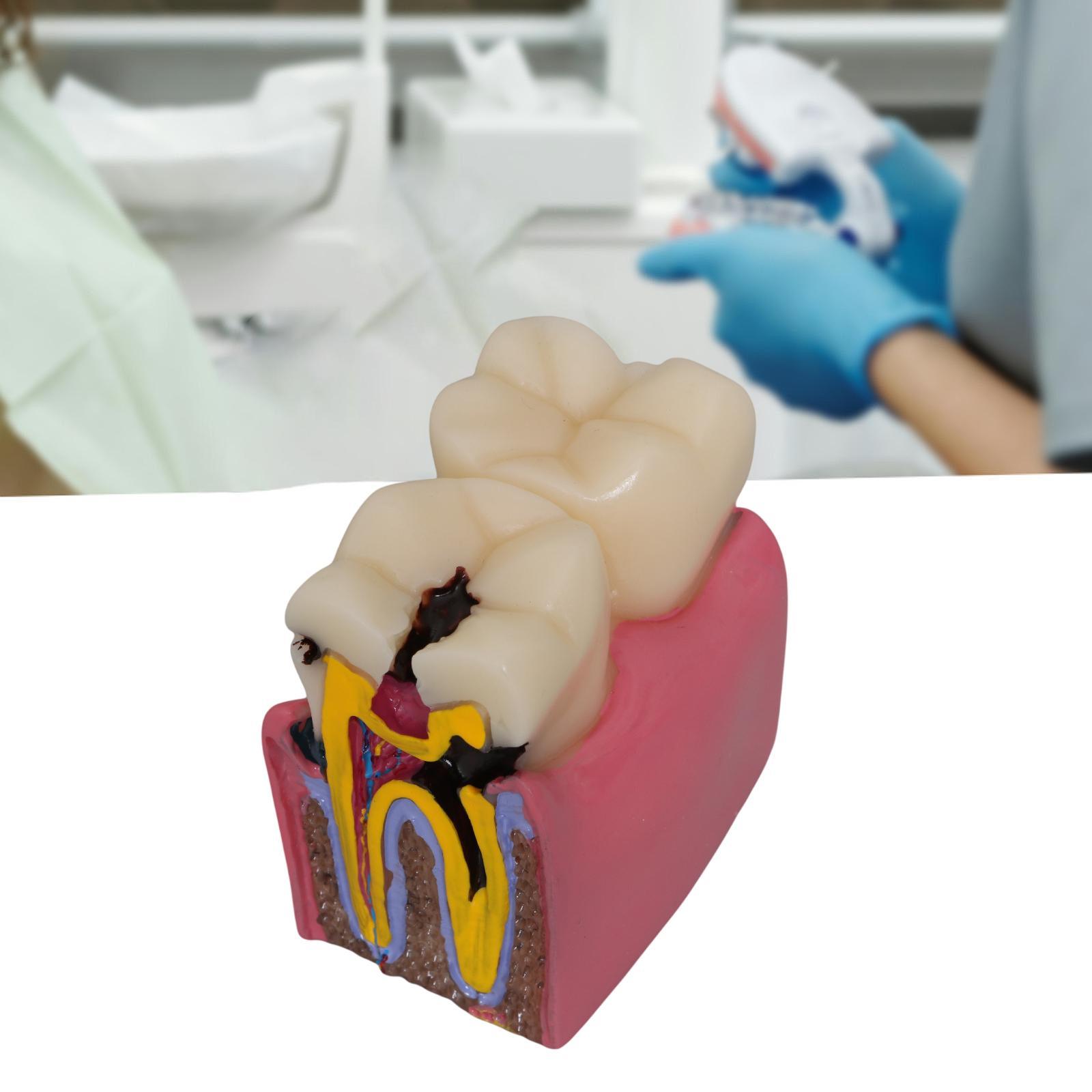 Modelo de cárie dentária, raíz - Kids Education Classes avaliação e preço