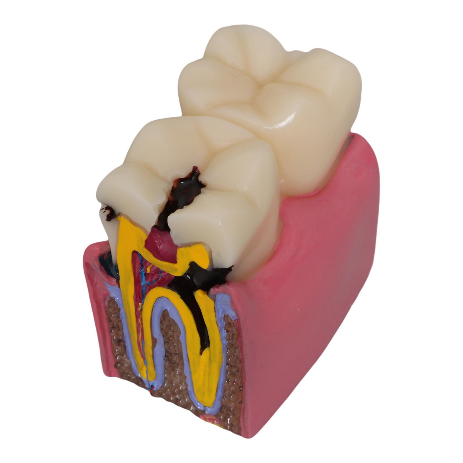 Modelo de cárie dentária, raíz - Kids Education Classes avaliação e preço
